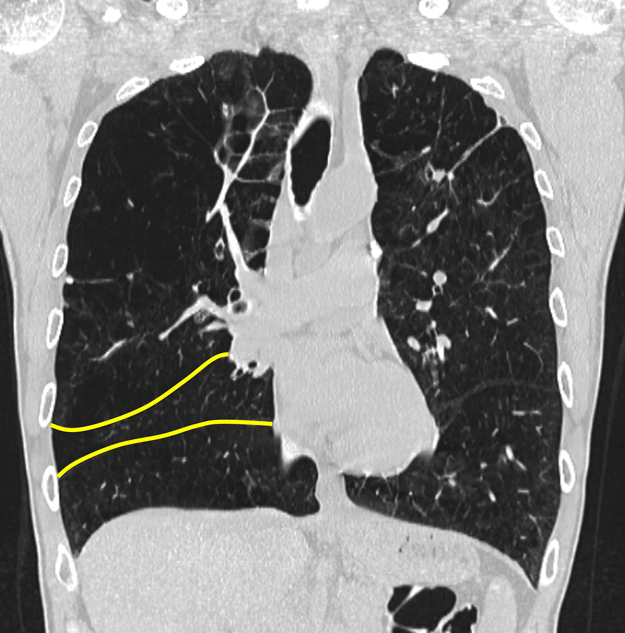 This image shows hyperinflation in a lung affected by COPD.
